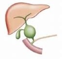 Choledochal Cyst